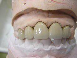 metallo ceramica