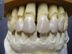 CERAMICA SU ZIRCONIA

